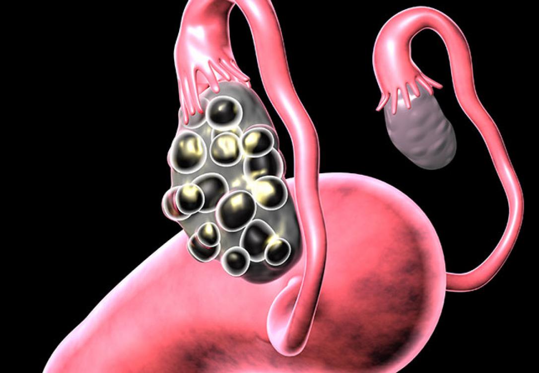 Polikistik Over Sendromu Nedir ? Belirtileri, Tanı ve Tedavisi Nasıldır?