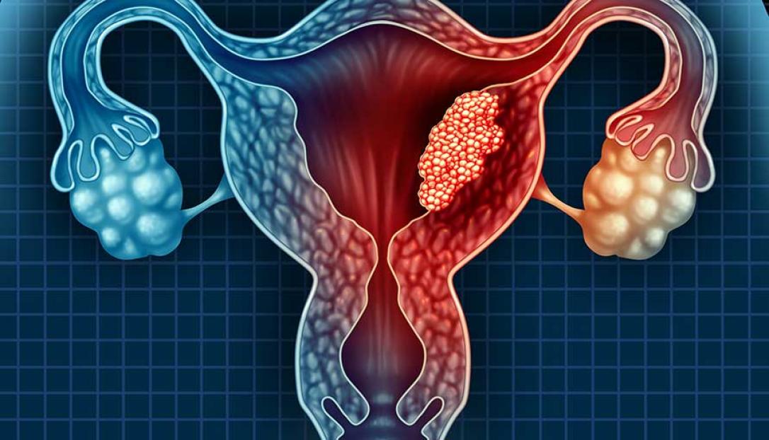 Rahim (Uterus) Kanseri: Nedir, Belirtileri, Tedavisi, Ameliyatı