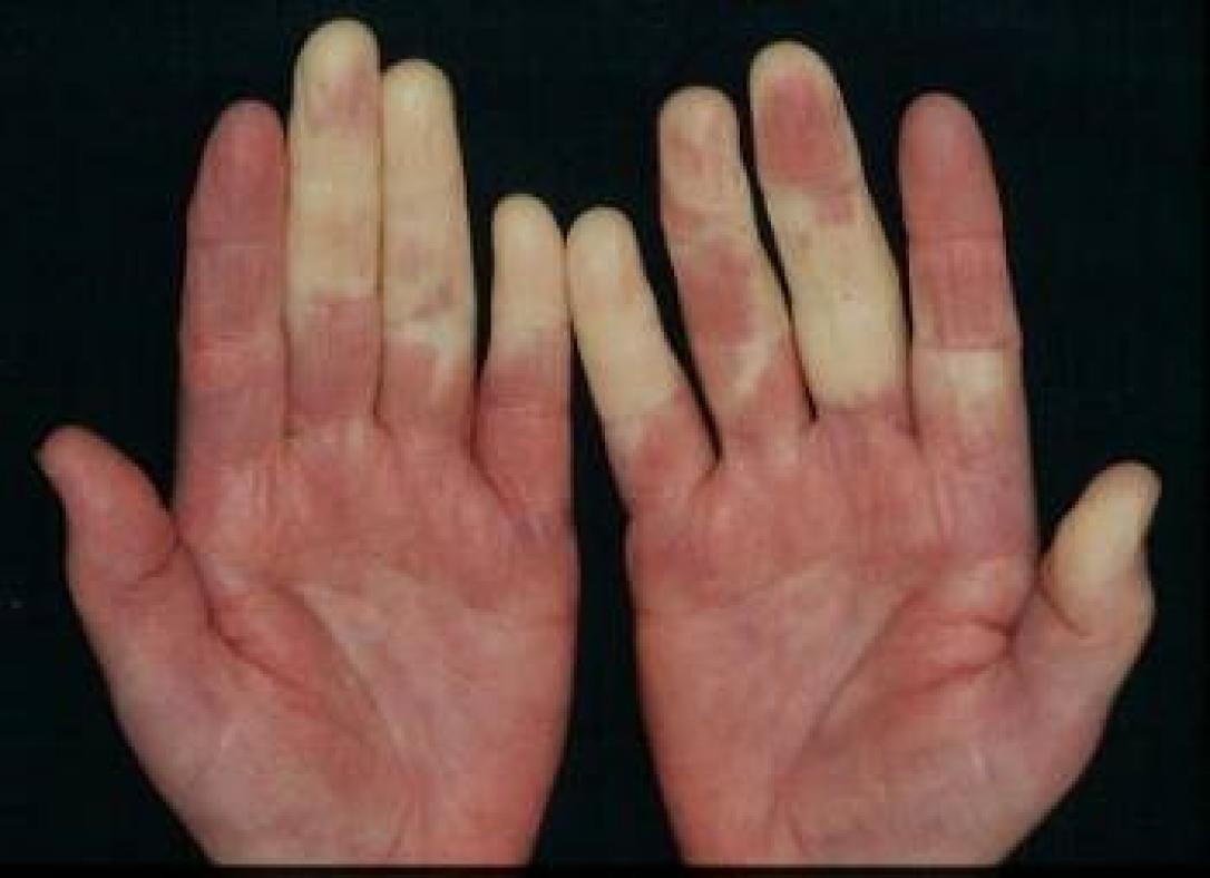 Raynaud Hastalığı (Fenomeni) Nedir? Belirtileri Nelerdir?