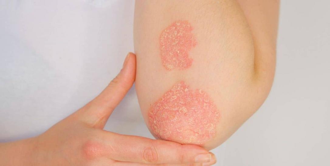 Sedef Hastalığı (Psoriazis) Nedir? Belirtileri Nedir? Tedavisi Nasıldır?