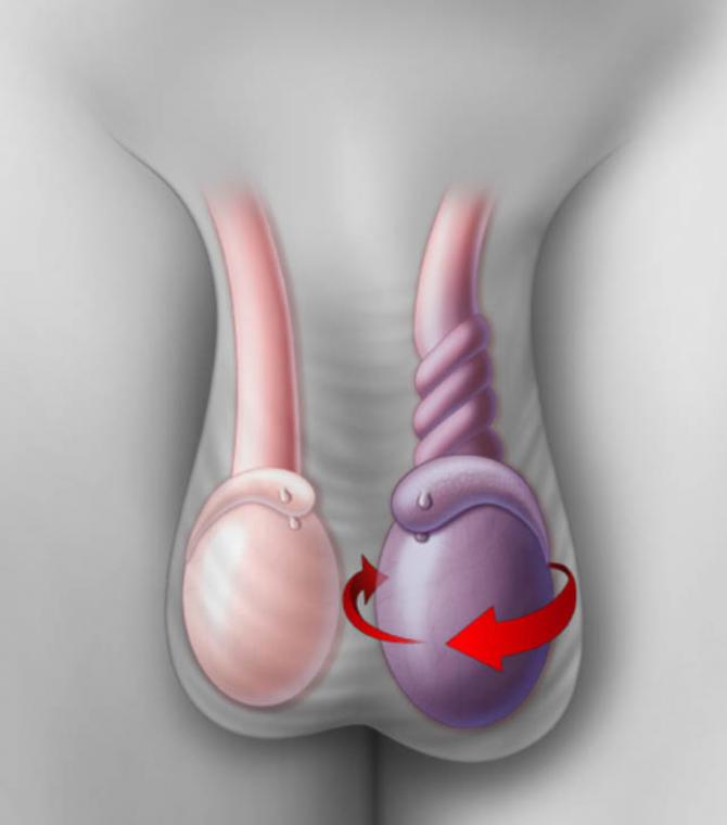 Testiste aniden ortaya çıkan ağrı testis torsiyonu olabilir.